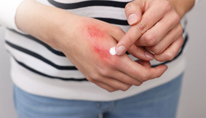 Bôi kẽm oxit giúp giảm triệu chứng do kiến ba khoang gây ra
