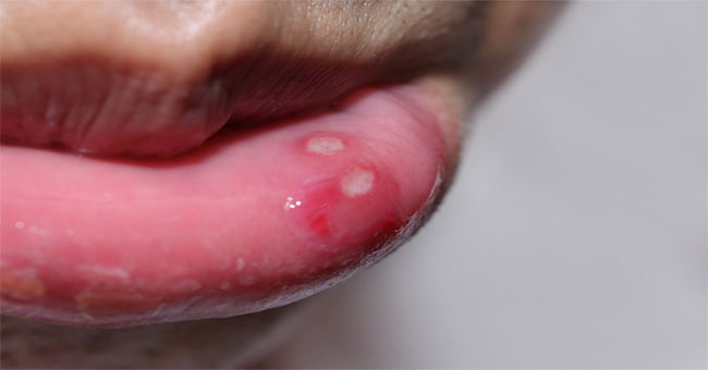 Nhiệt Miệng: Nguyên Nhân, Triệu Chứng Và Giải Pháp Hiệu Quả