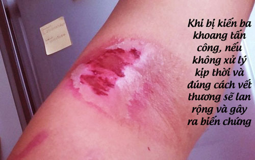 Nếu không được xử lý kịp thời, vết đốt kiến ba khoang có thể gây biến chứng