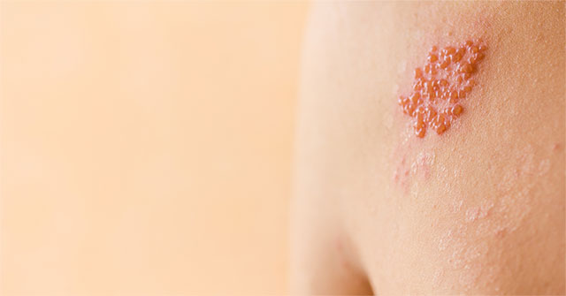 Tìm Hiểu Về Bệnh Zona Thần Kinh: Triệu Chứng, Nguyên Nhân Và Cách Điều Trị