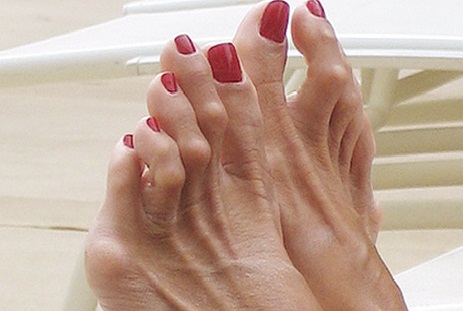 Đi dép xỏ ngón gây biến dạng ngón chân