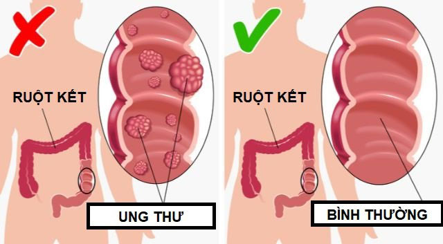 loi-ich-khi-an-dua-chuot-moi-ngay-2 Giảm nguy cơ ung thư