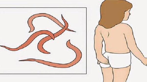 Xử lý giun kim ở trẻ tại nhà: phương pháp dân gian, an toàn và những lưu ý