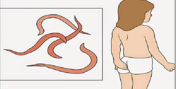 giun-kim Giun kim thường tụ tập ở hậu môn của trẻ, gây ngứa ngáy khó chịu.